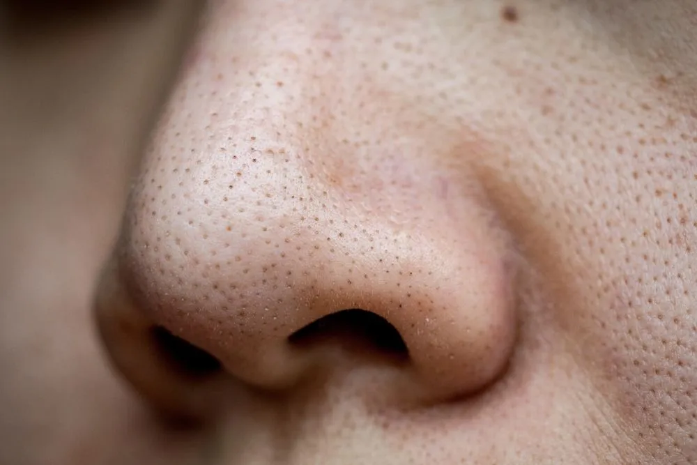 Principales causes des pores dilatés