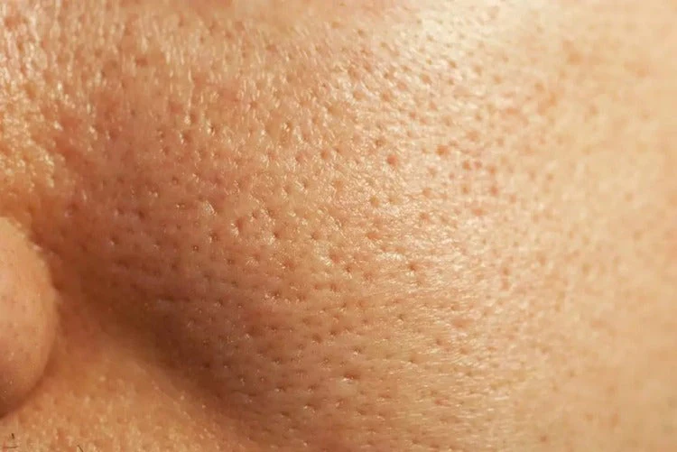 Pores dilatés