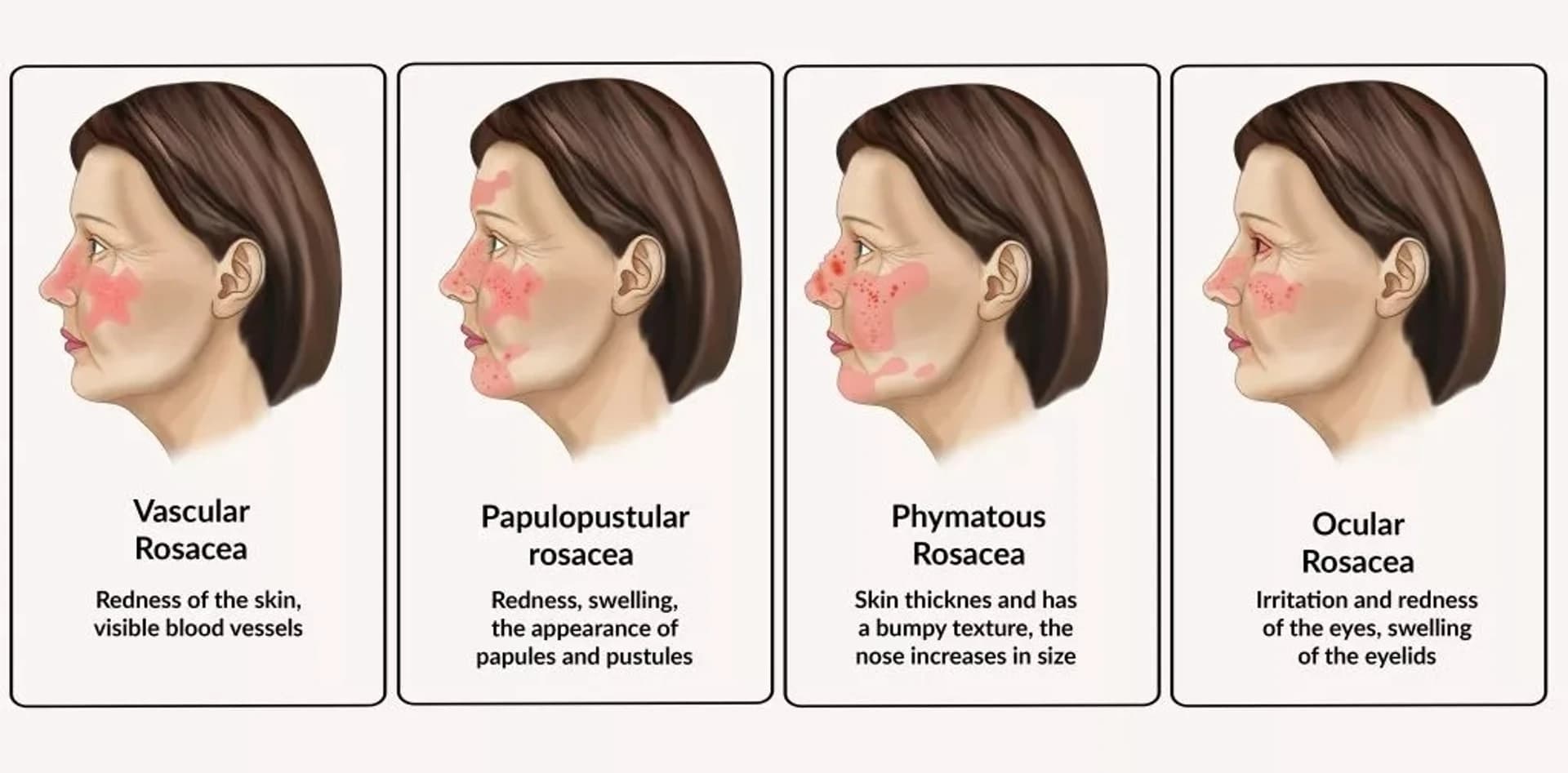 La rosacée et ses déclencheurs : guide détaillé