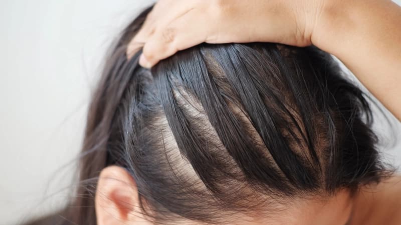 perte de cheveux