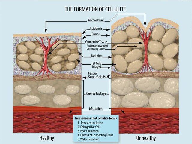 Étiologie de la cellulite. Pourquoi la cellulite apparaît-elle ?