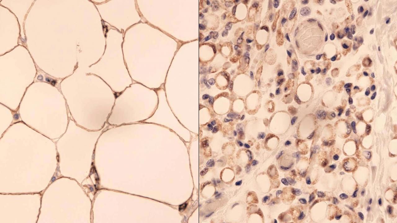 Étiologie de la cellulite. Pourquoi la cellulite apparaît-elle ?