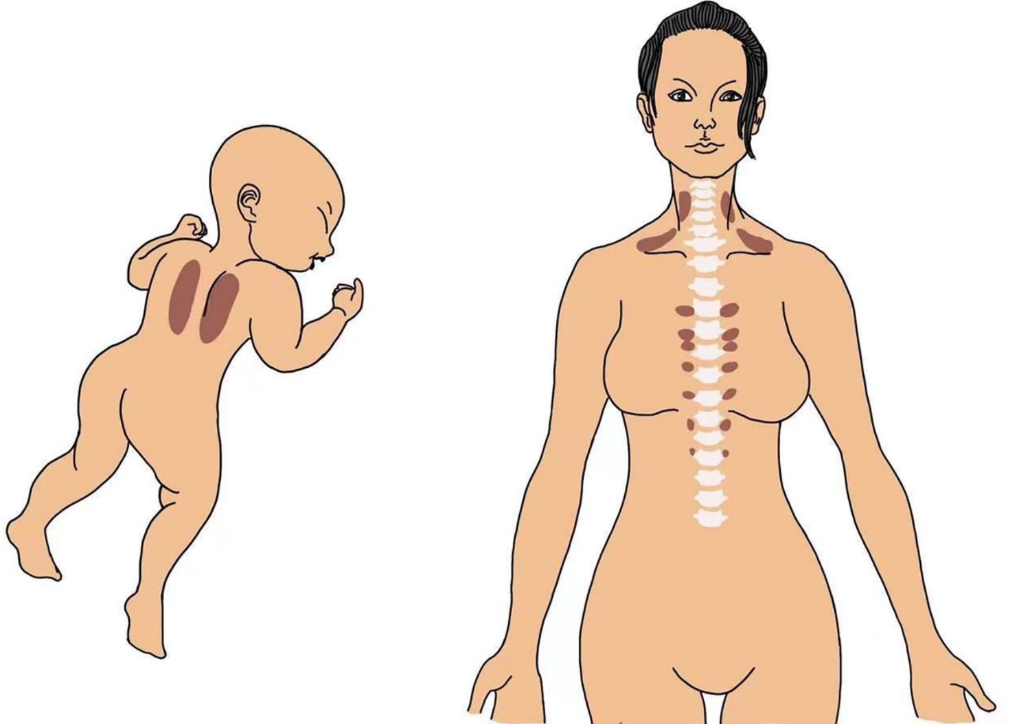 Étiologie de la cellulite. Pourquoi la cellulite apparaît-elle ?