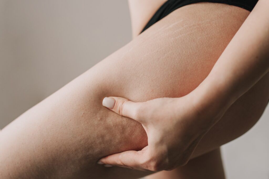 Étiologie de la cellulite. Pourquoi la cellulite apparaît-elle ?