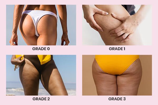 Étiologie de la cellulite. Pourquoi la cellulite apparaît-elle ?
