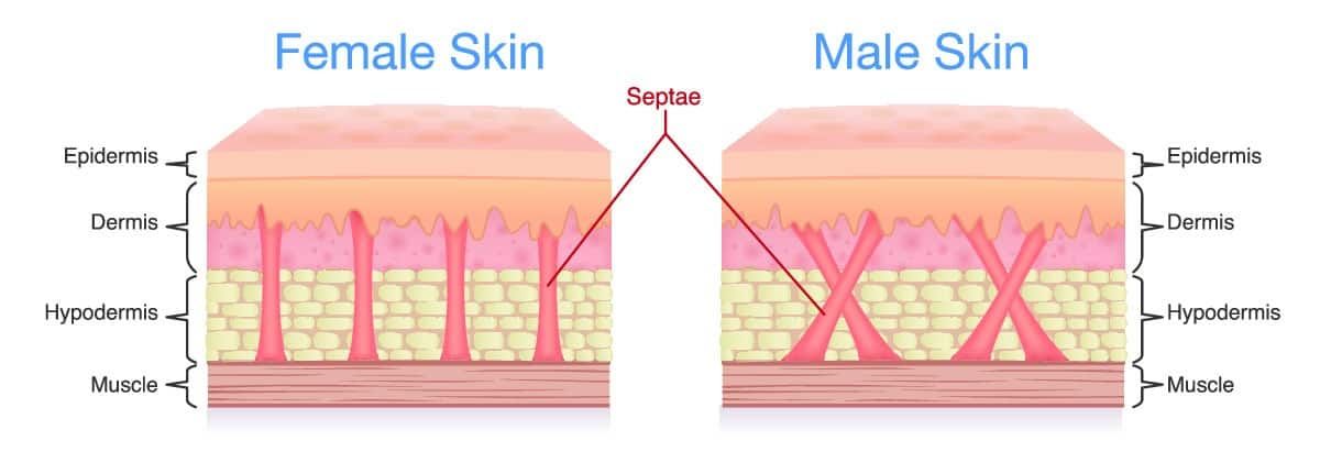 Étiologie de la cellulite. Pourquoi la cellulite apparaît-elle ?