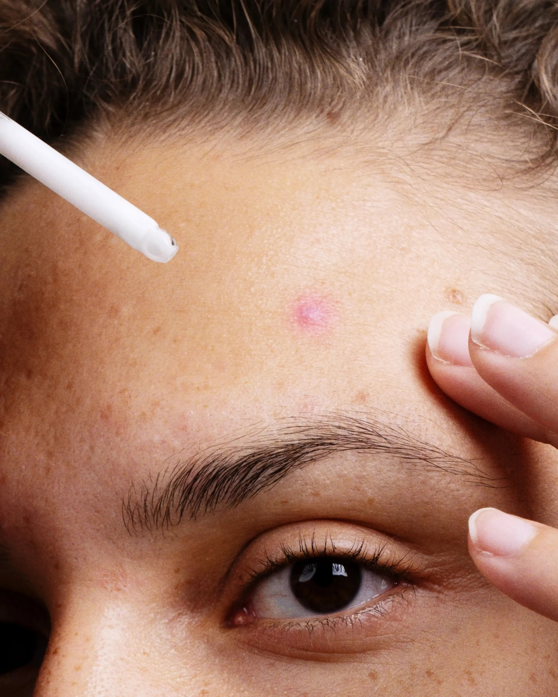 La niacinamide aide-t-elle contre l’acné?