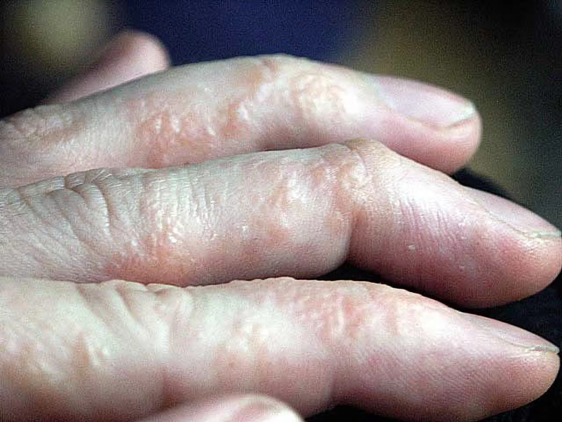 Eczéma dyshidrosique — dermatite des mains et des pieds