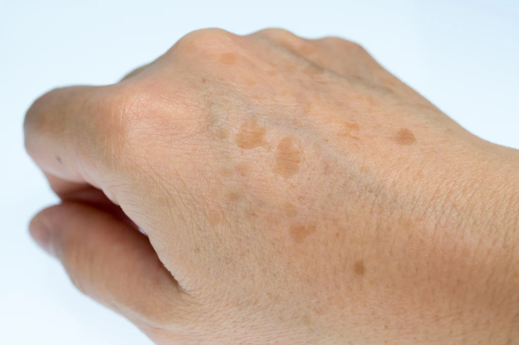 Comment traiter les taches de vieillesse sur les mains ?