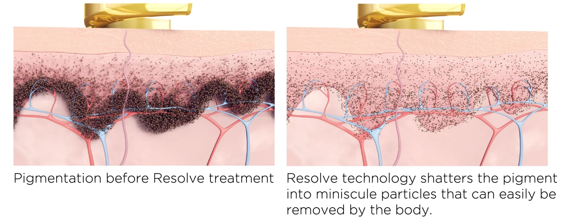 Comment traiter les taches de vieillesse sur les mains ?