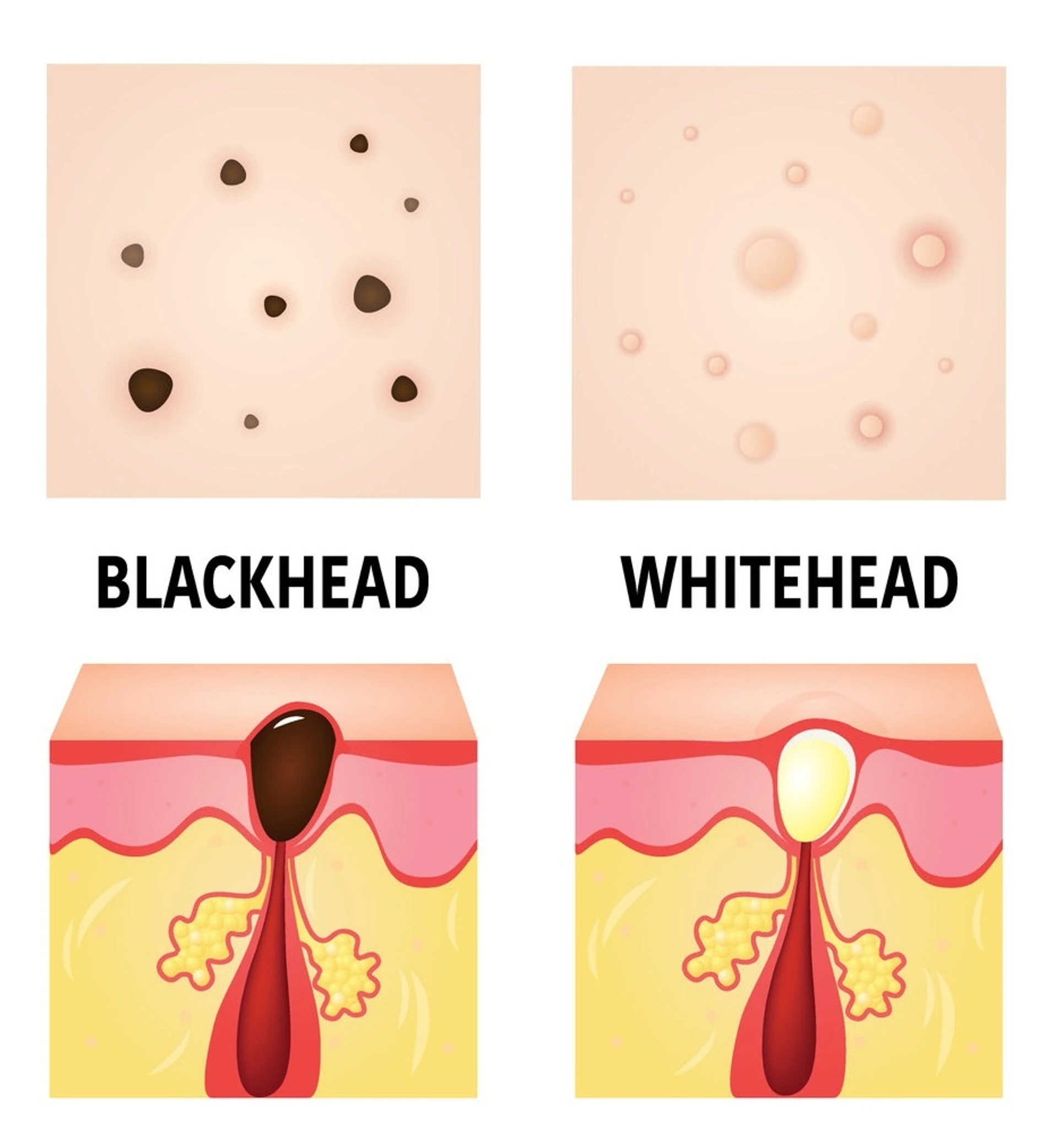 Comédons : ouverts et fermés