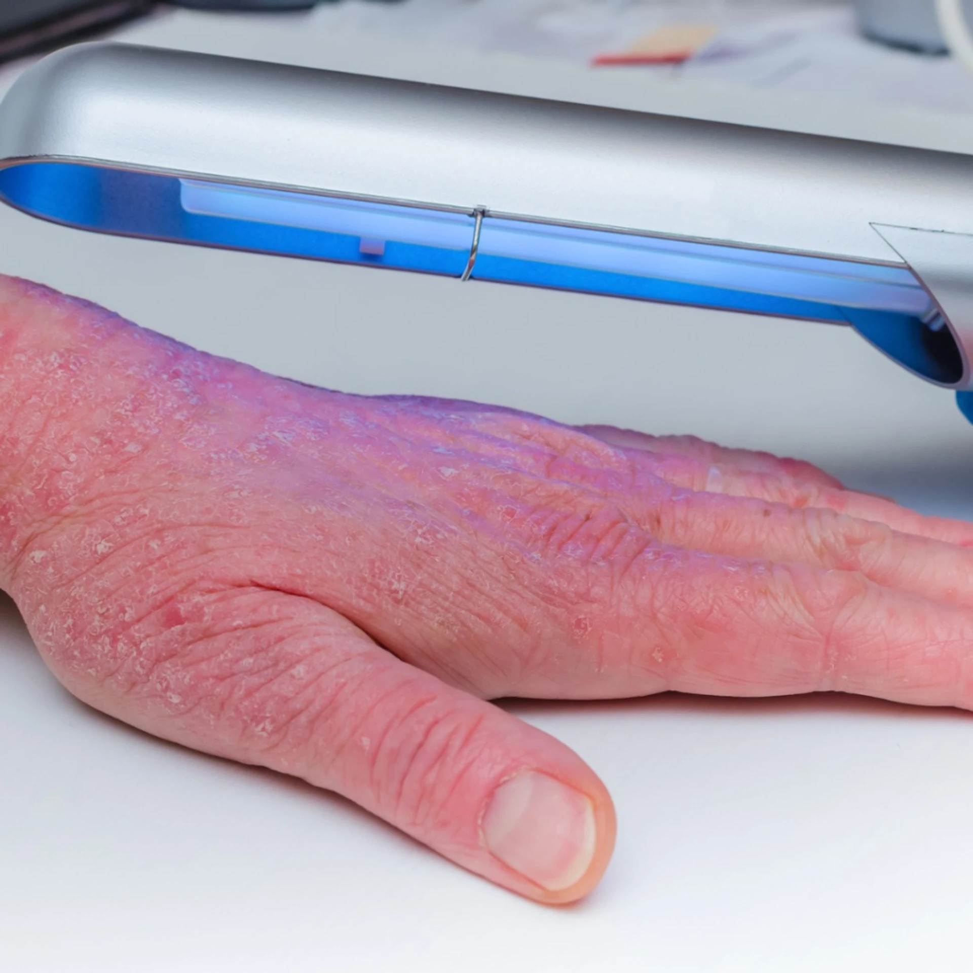 Approches alternatives pour le traitement de l’eczéma chronique des mains