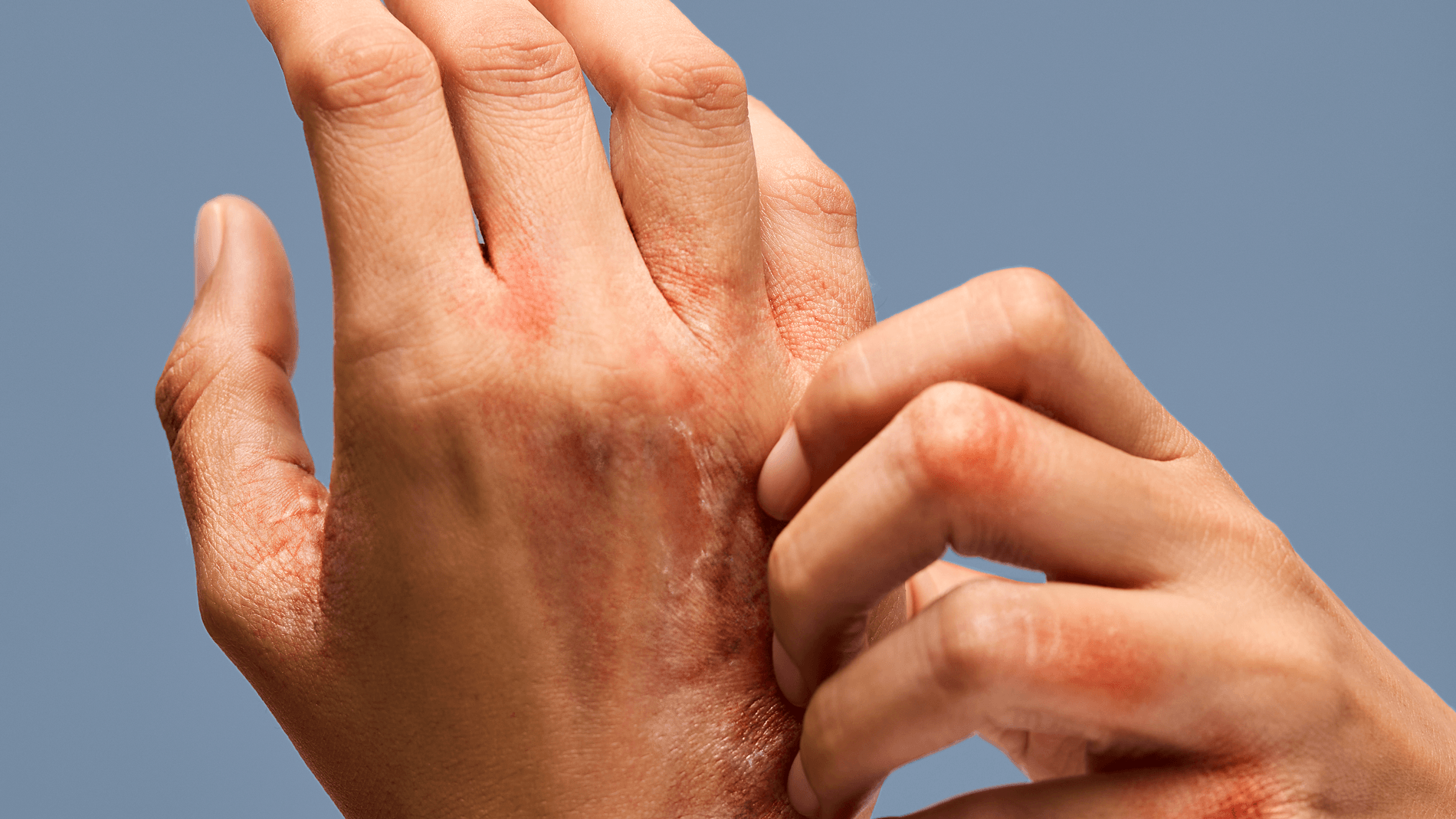 Approches alternatives pour le traitement de l’eczéma chronique des mains