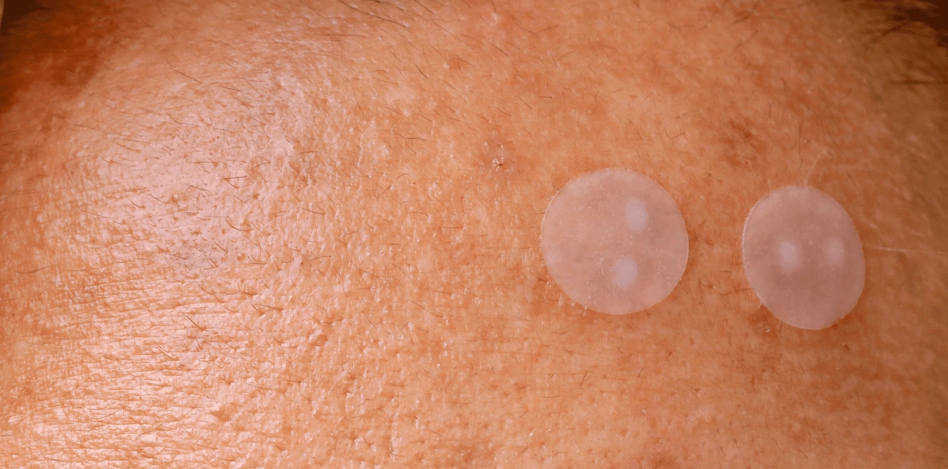 Patchs Boutons Acne – quelle est l’efficacité des autocollants contre l’acné ?