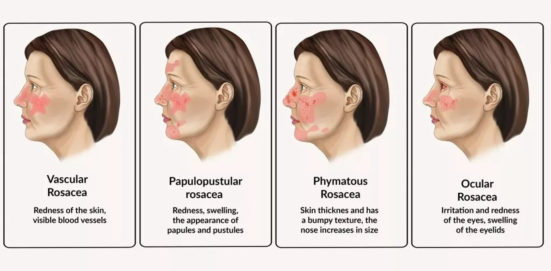 La rosacée et ses déclencheurs : guide détaillé
