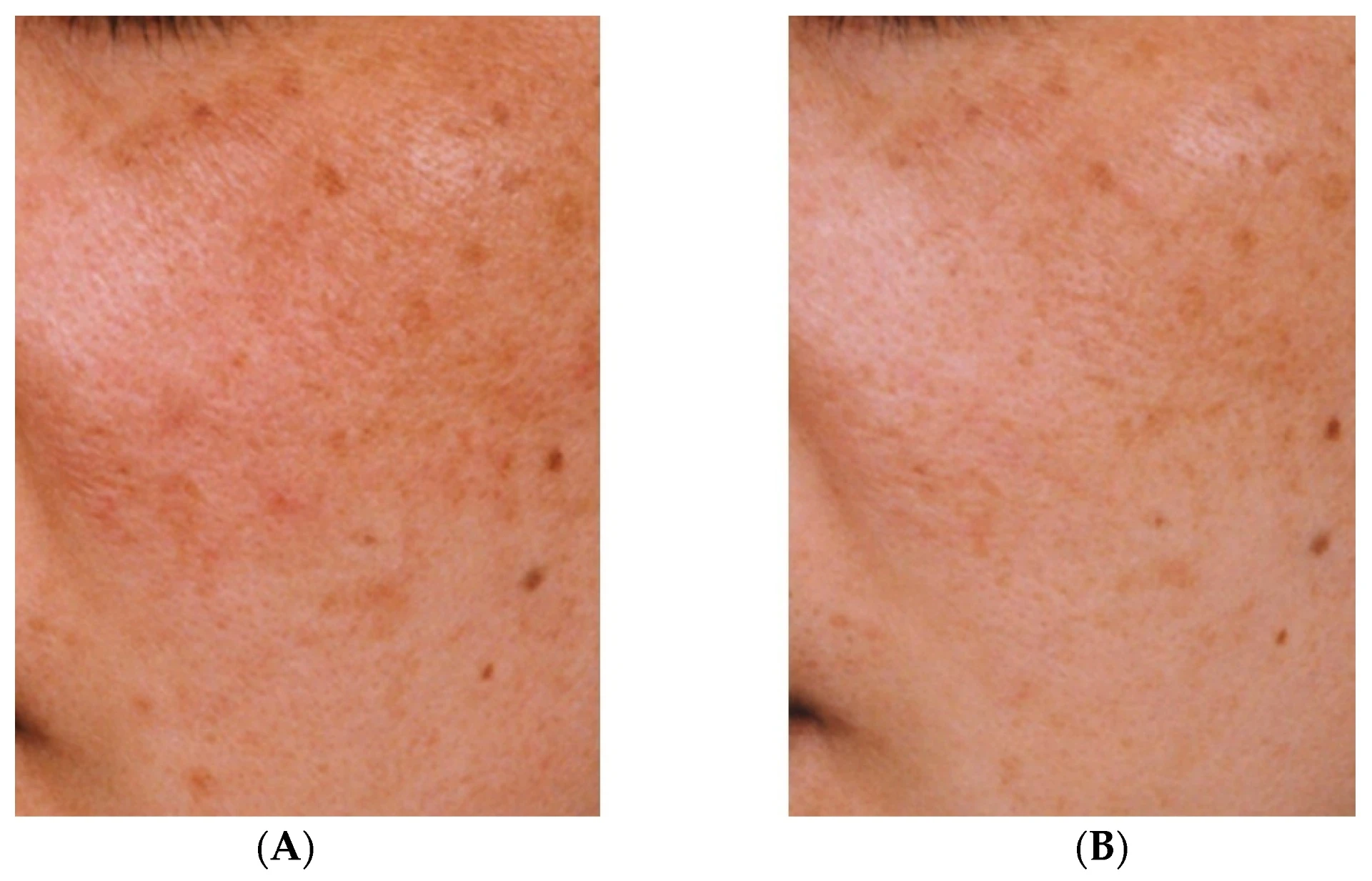 Acide tranexamique : un traitement efficace contre l’hyperpigmentation