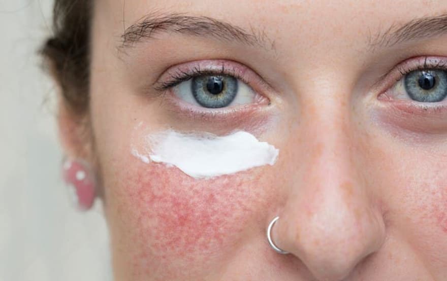 Bienfaits de l'acide azélaïque pour la rosacée