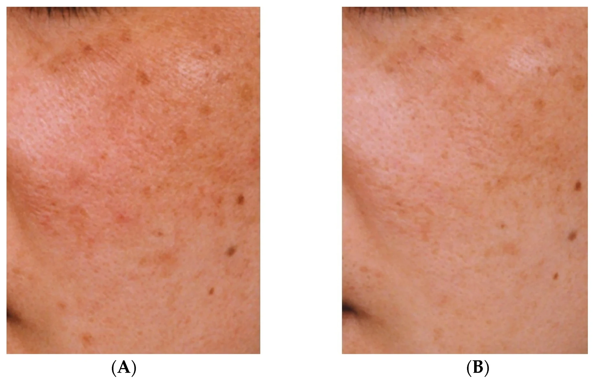 Acide tranexamique pour le mélasma : bienfaits et effets secondaires