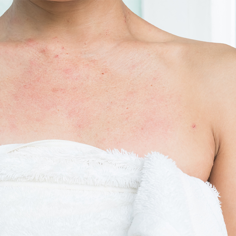 Peau atopique : comment choisir ses soins étape par étape sans se tromper sur la composition