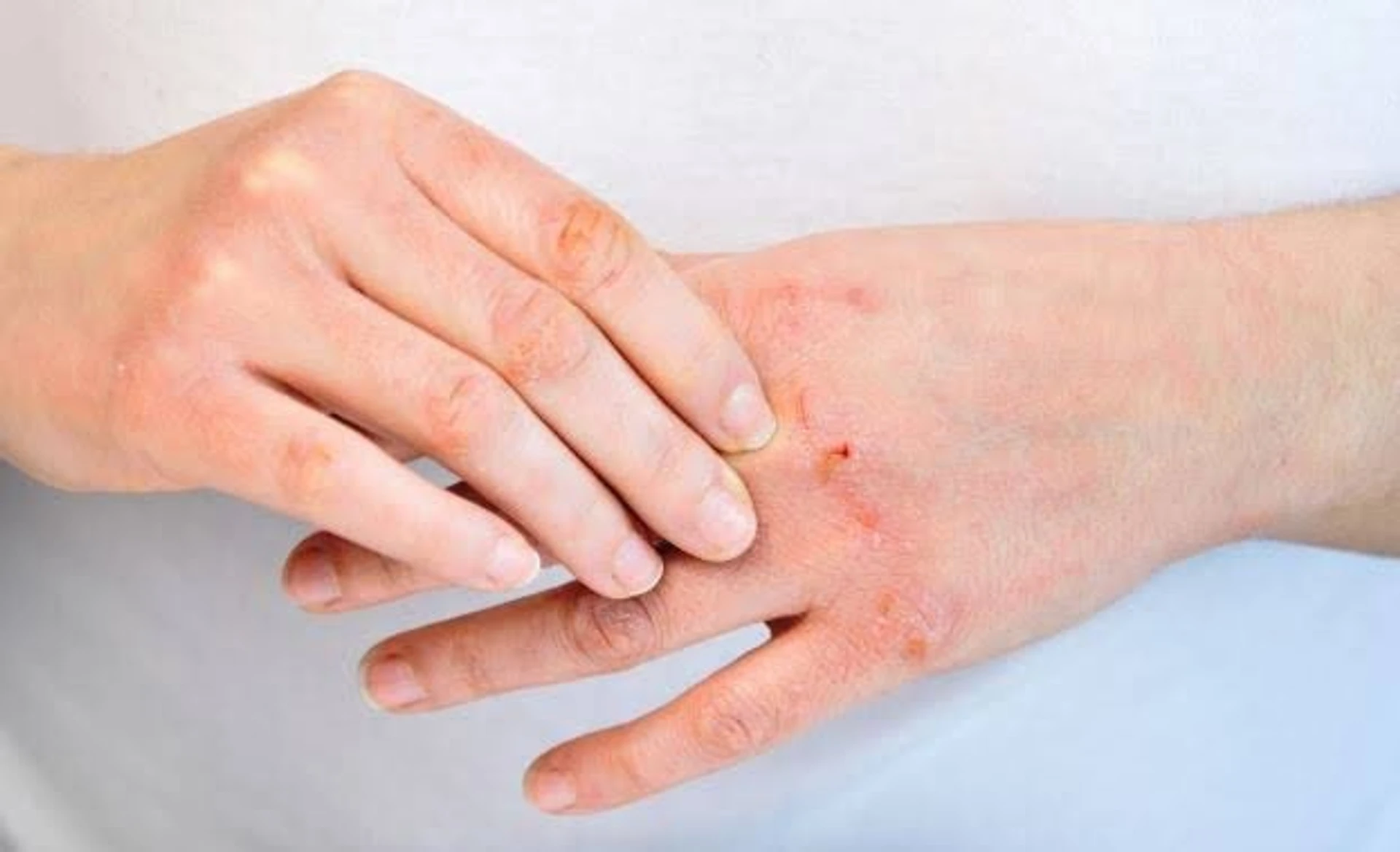 Peau atopique : comment choisir ses soins étape par étape sans se tromper sur la composition